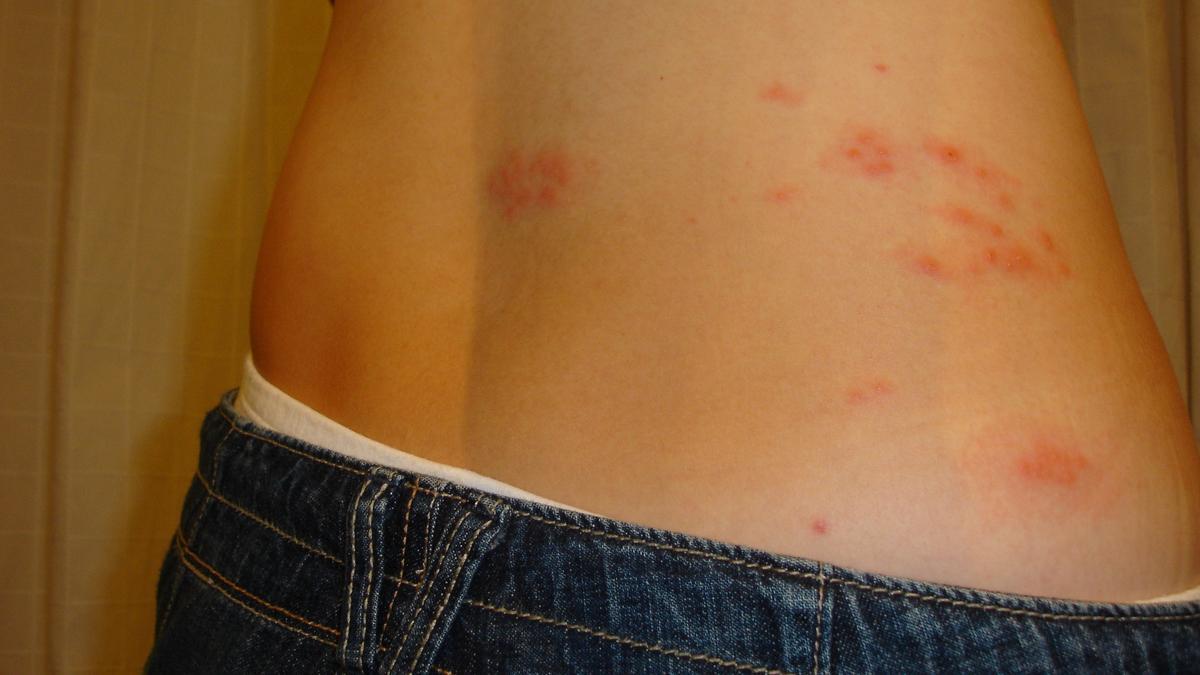 Herpes Zóster fotos | Así es el herpes zóster que provoca el virus de la varicela