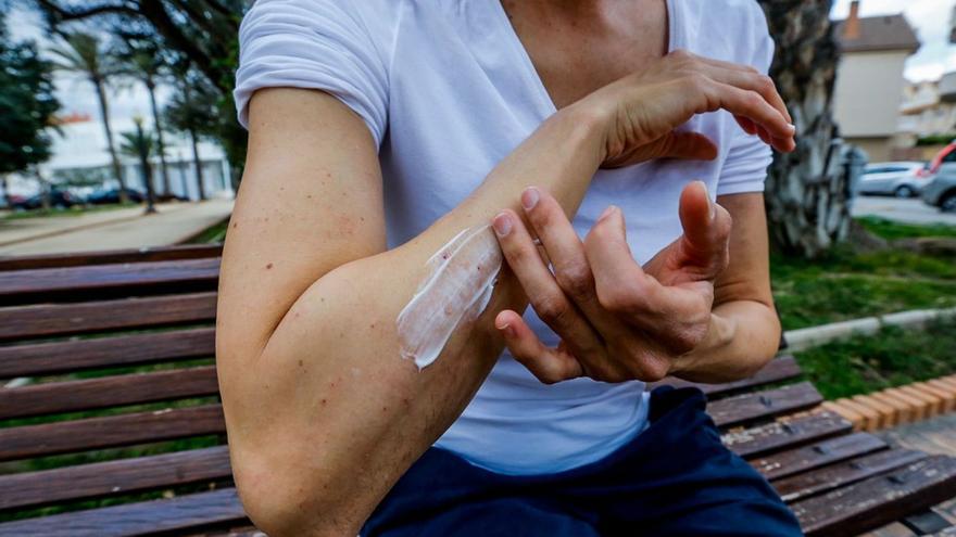 Dermatólogos alertan de una «epidemia» de sarna en Mallorca