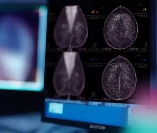 El mamógrafo 3D más avanzado para detectar el cáncer de mama