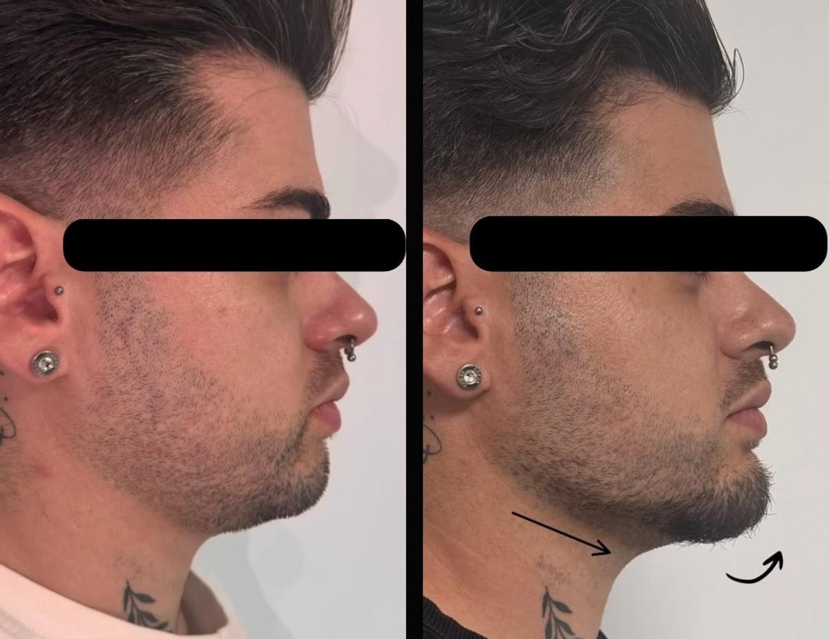Tratamiento orientado a mejorar la definición del contorno facial y la mandíbula en un paciente masculino realizado por Herrera.