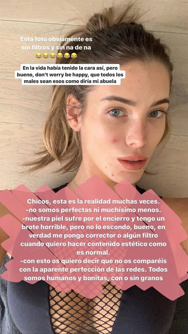 Marta López Álamo muestra su acné