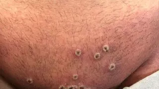 Los virólogos del HUCA, preparados para detectar la viruela del mono