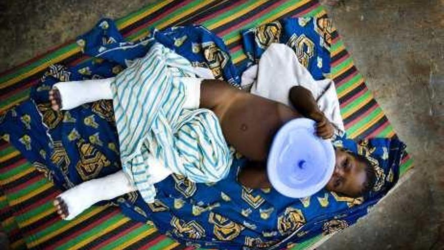 Un niño operado de ambas piernas por Oasis en Togo.