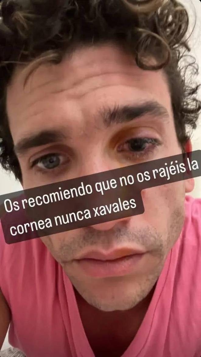 Jaime Lorente y la foto en Instagram para contar que se rajó la cornea