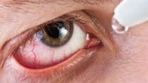 Administración de gotas en un ojo con síntomas de conjuntivitis