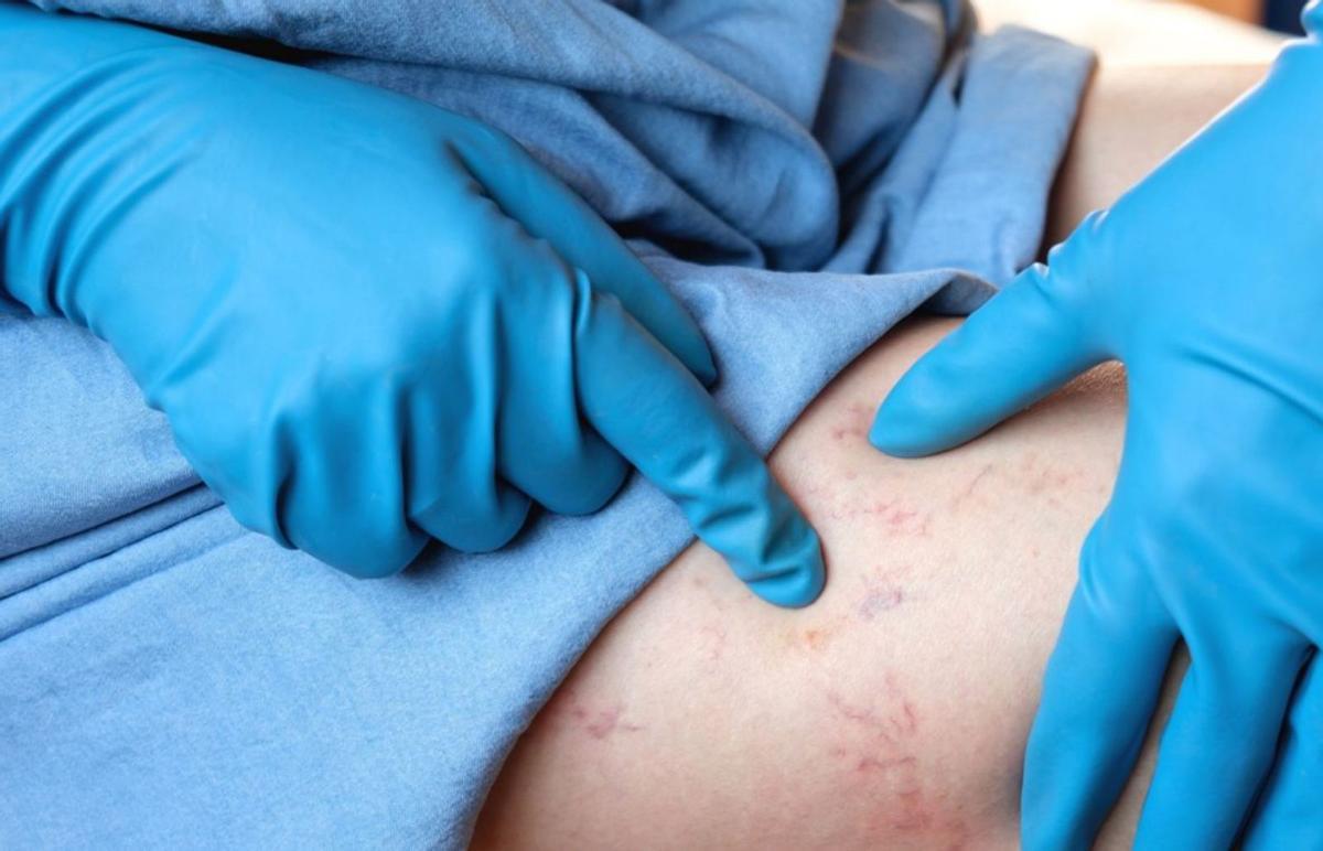 Los procedimientos vasculares deben realizarlos especialistas en medicina. | FOTOS: SHUTTERSTOCK