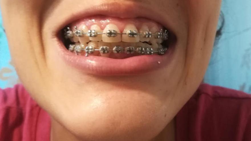 Instantánea que muestra el estado de los &#039;brackets&#039; que lleva Sheila Fuentes, afectada por la franquicia.