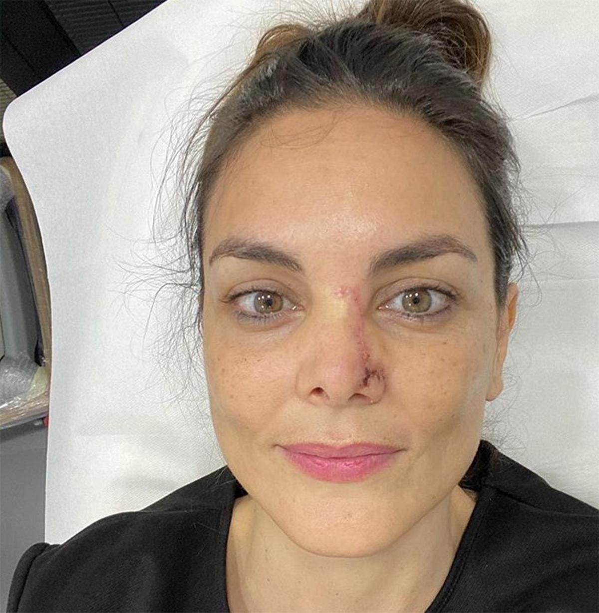 Monica Carillo cancer de piel nariz cicatriz