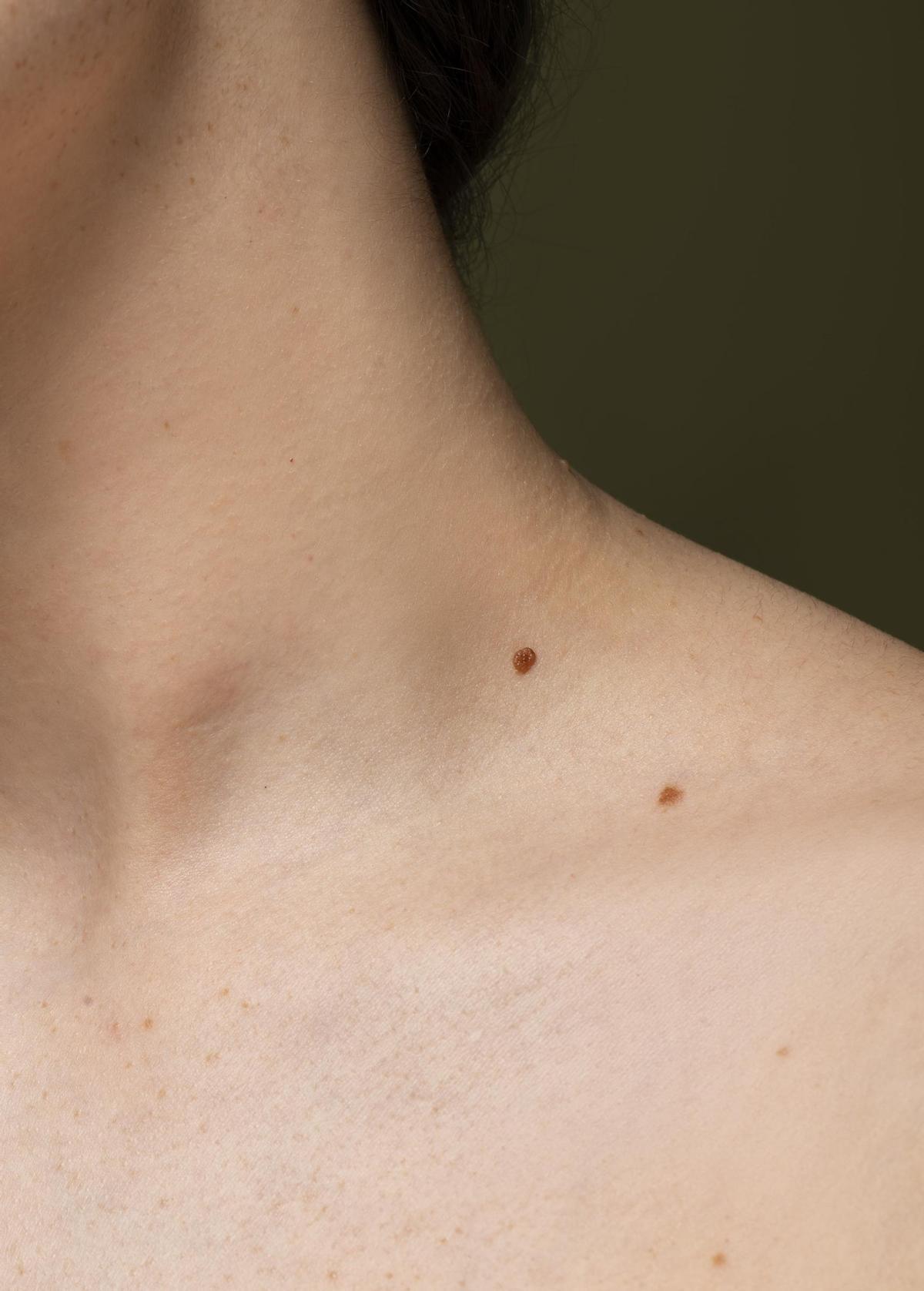 La detección precoz del melanoma puede ser determinante para un tratamiento eficaz y, en muchos casos, para la curación.