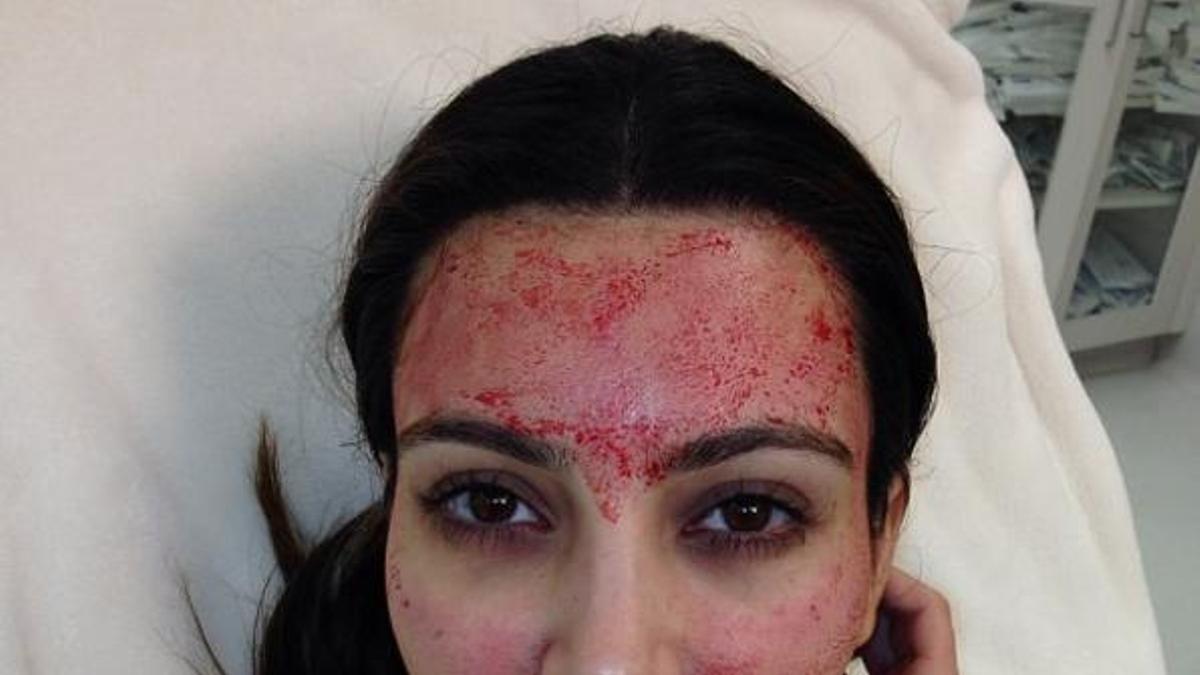 Kim Kardashian con el tratamiento 'vampiro facial'