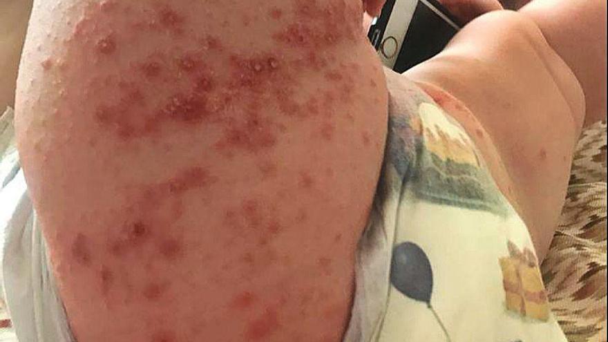 Inquietud por un virus que afectó a 50 niños británicos en Alcúdia: &quot;Horrible&quot;