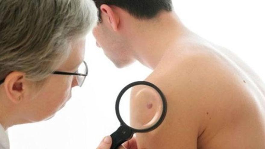 La detección precoz del melanoma fundamental para un mejor pronóstico