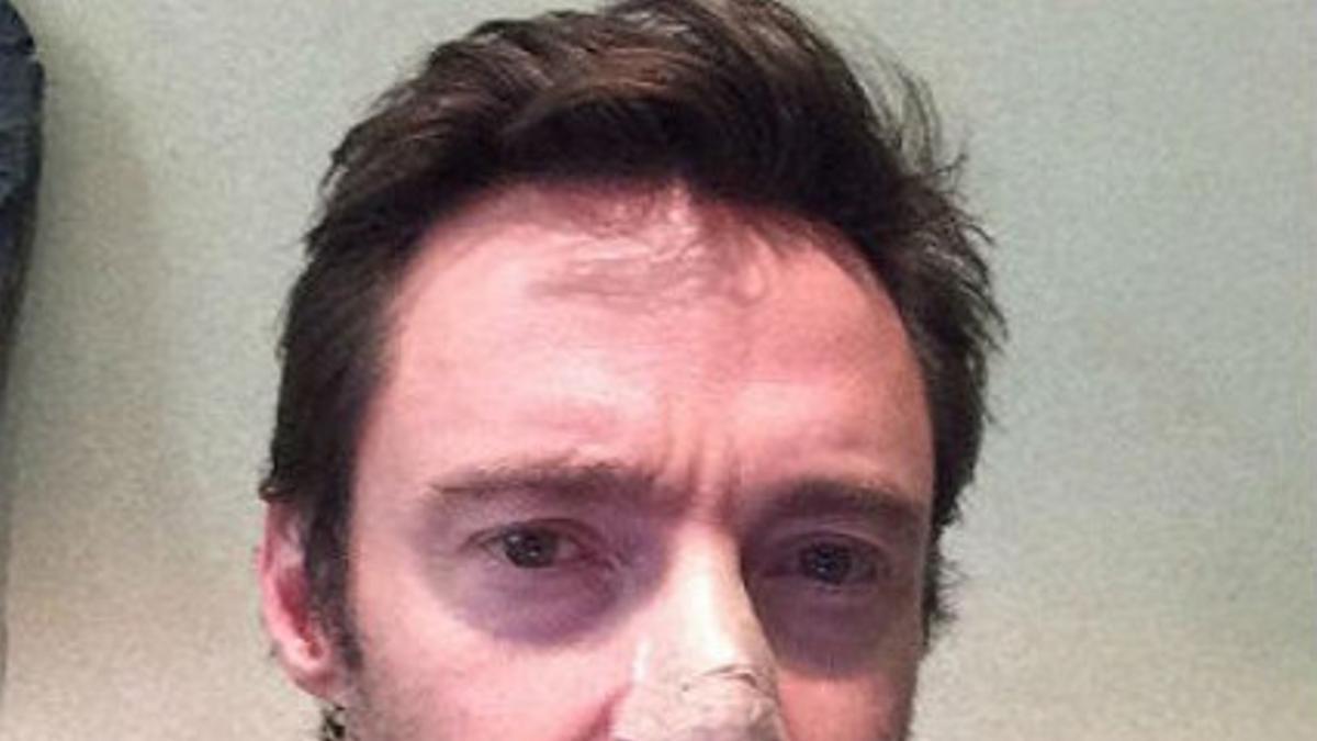 Hugh Jackman, con tiritas en la nariz, en la foto que ha colgado en Instagram.