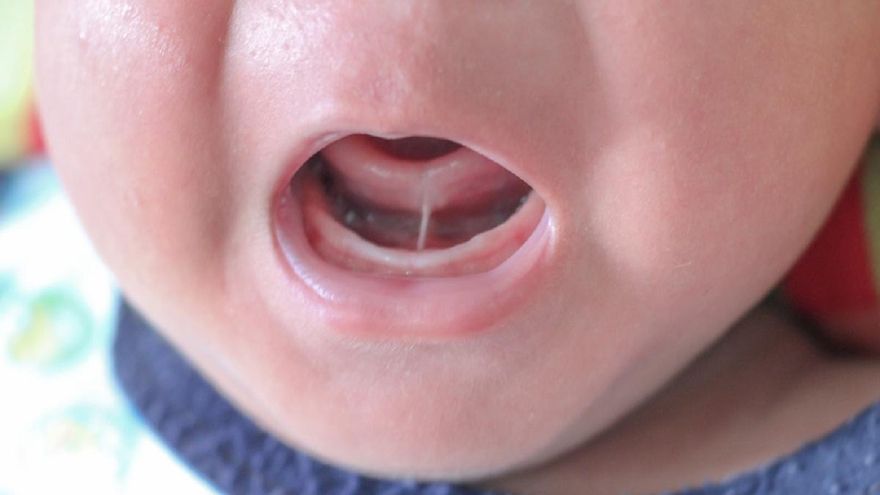 Frenectomía en bebés: por qué a veces no funciona como esperabas