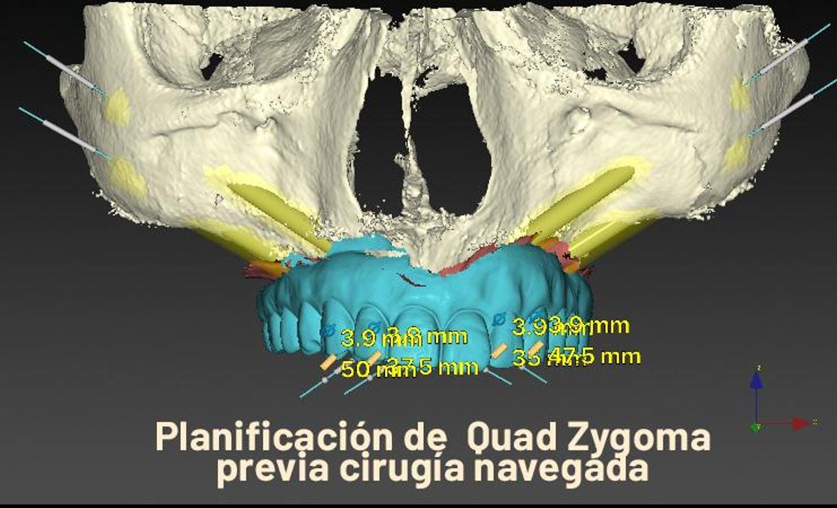 Planificación de Quad Zygoma previa cirugía navegada.