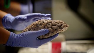 La mitad de las personas que están comenzando a padecer alzhéimer todavía no lo saben