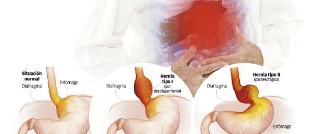Hernia de hiato: cuando el ácido gástrico toma el camino equivocado