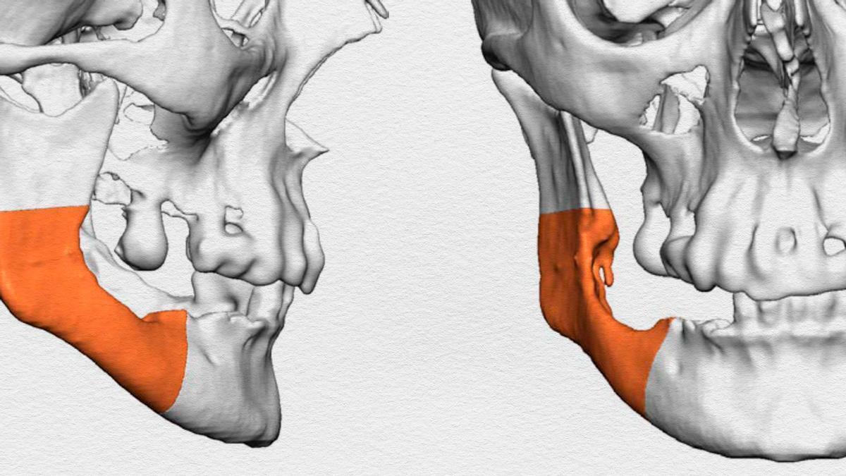 Reproducciones de una planificación virtual para la reconstrucción de un cáncer mandibular utilizando un colgajo microvascularizado de peroné, una cirugía realizada en Cabueñes.