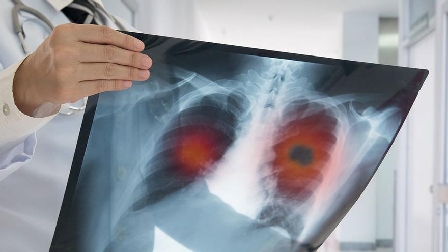 Muere una mujer de cáncer de pulmón por una negligencia médica