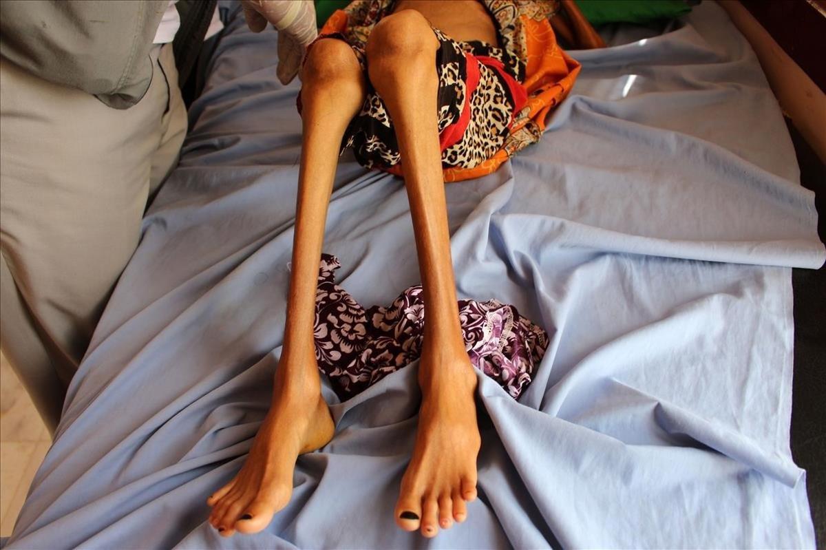 Fatima Hadi, una niña yemení desplazada de 12 años que sufre de desnutrición aguda, yace en una cama en un hospital en la provincia de Hajjah, noroeste de Yemen.