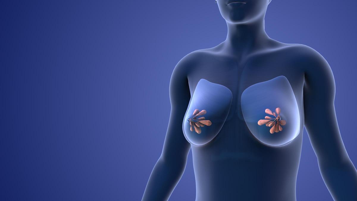 La importància de la mastopèxia