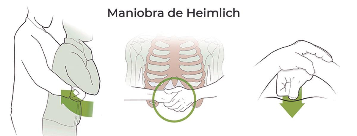 Imagen de la maniobra de Heimlich