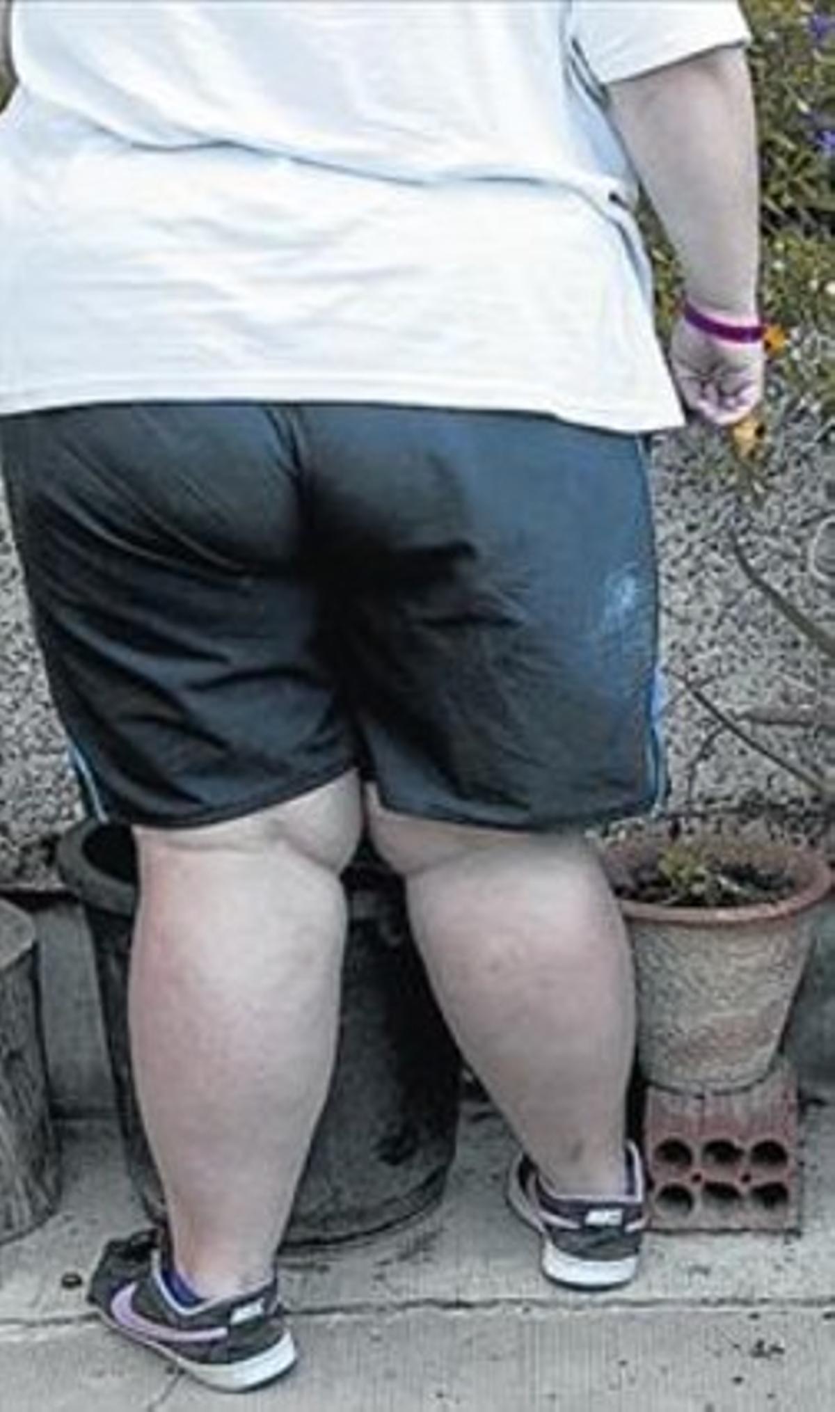 Una niña con obesidad extrema. Una niña con obesidad extrema.