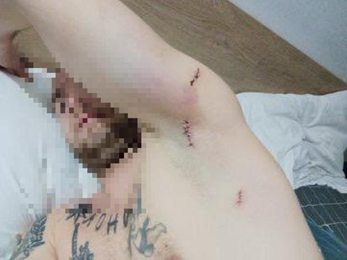 Uno de los donostiarras herido en la axila muestra el pinchazo