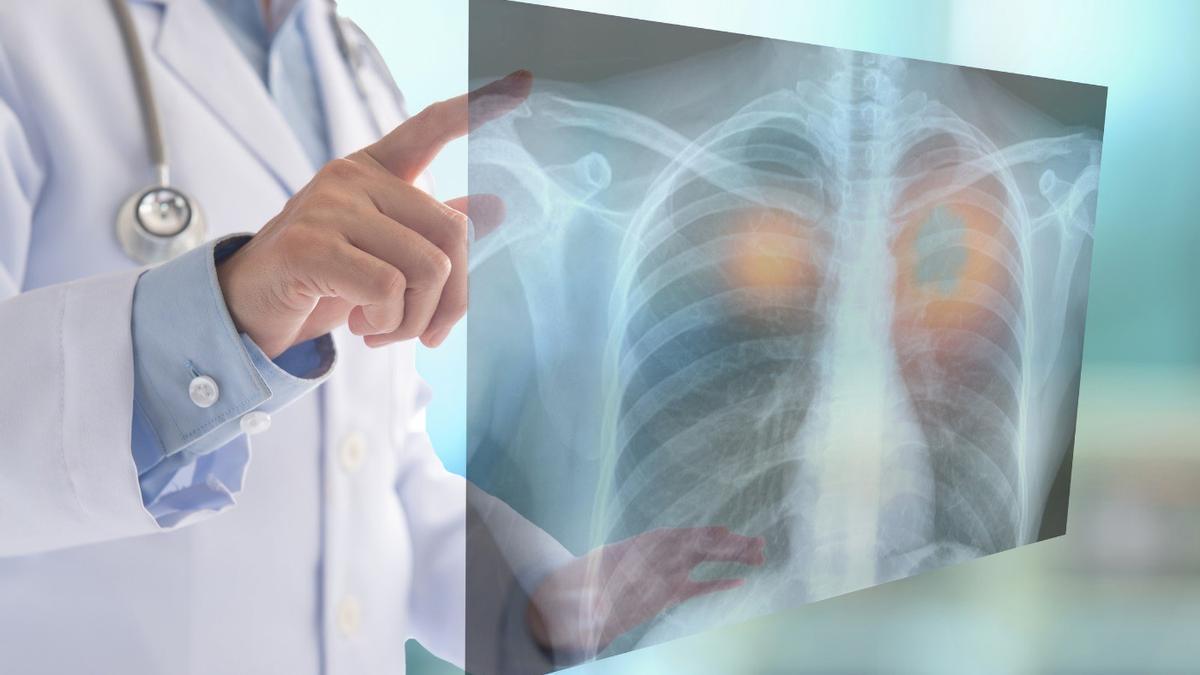 Imagen de una radiografía de los pulmones.