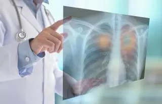 Una nova teràpia millora els resultats en un càncer de pulmó que es diagnostica en no fumadors i és resistent als tractaments habituals