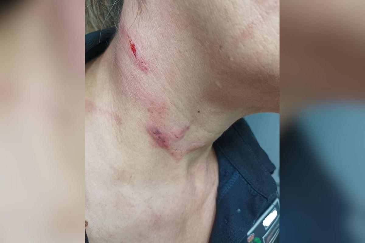 Marcas en el cuello de la funcionaria agredida por una reclusa peligrosa en la cárcel de Picassent