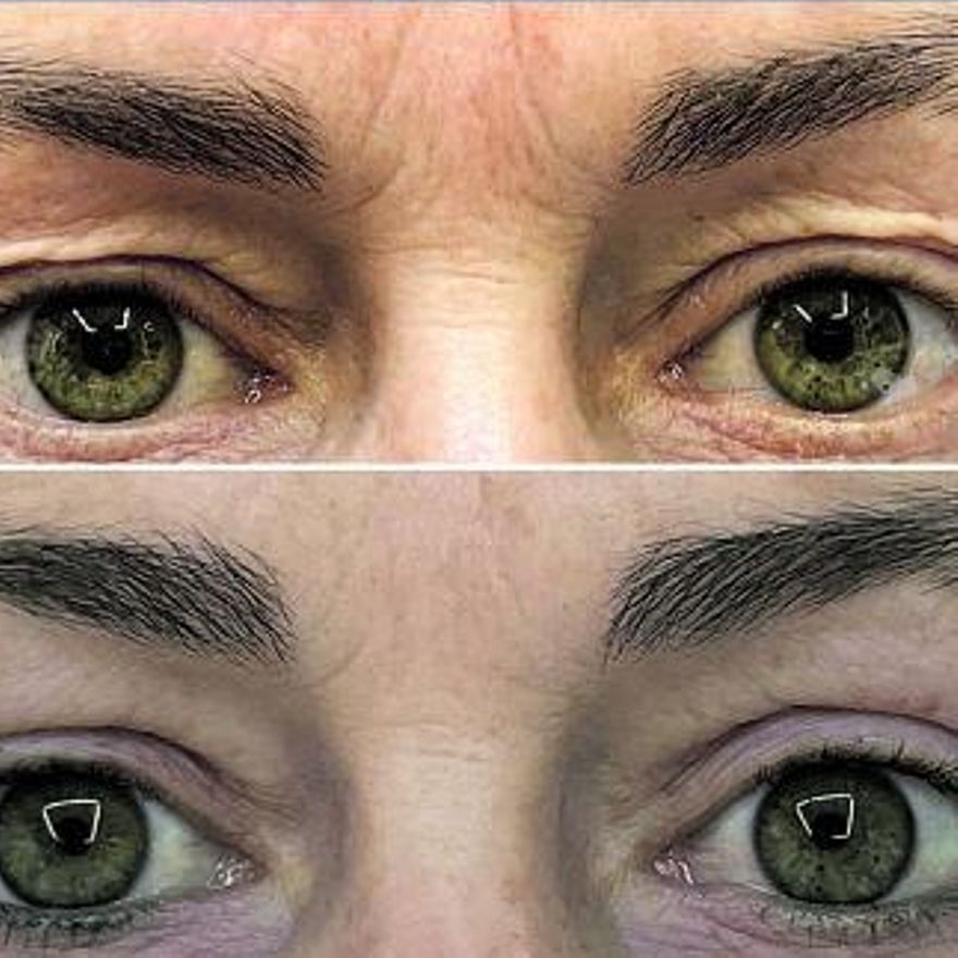 Un ejemplo de blefaroplastia superior. |