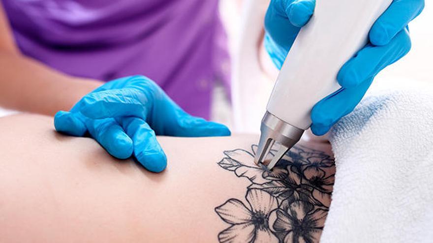 Elimina ese tatuaje que ya no te gusta o rejuvenece tu rostro con este tratamiento láser