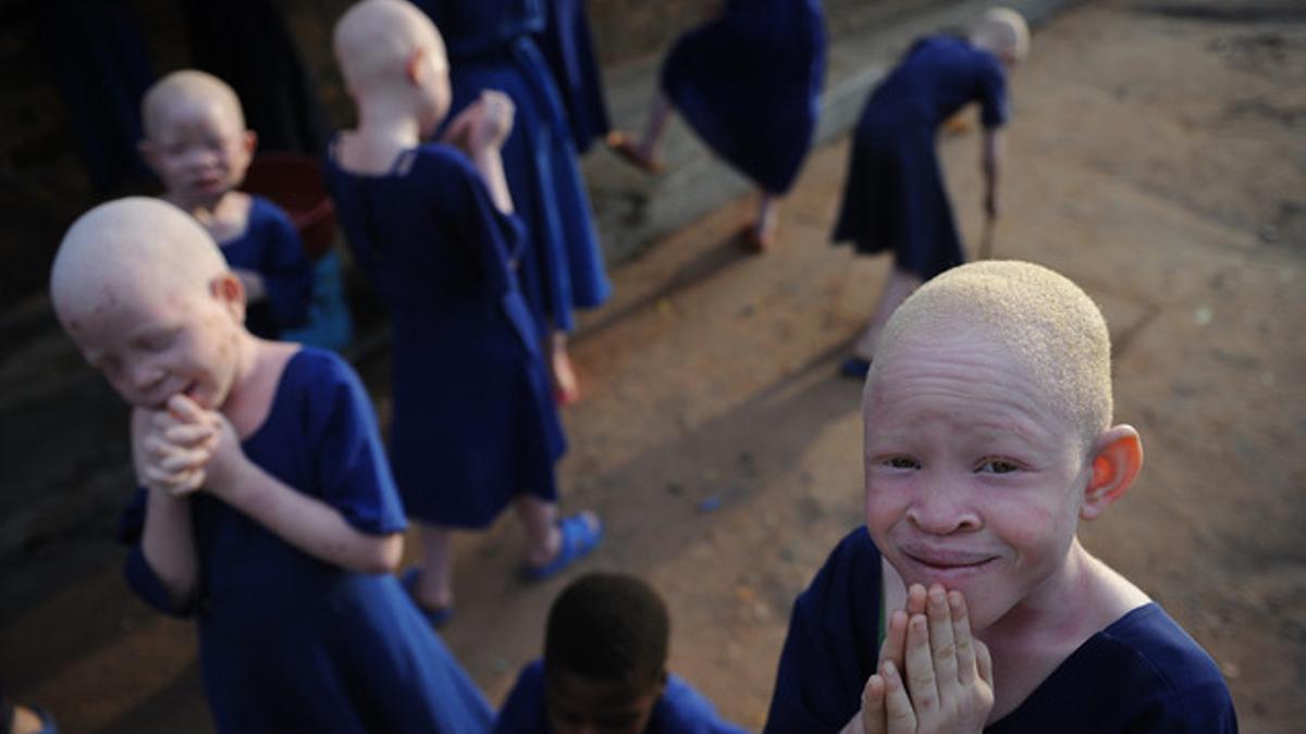 albinos en Tanzania