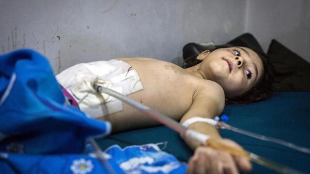 Un niño de 5 años se recupera de las heridas por restos de metralla en bombardeos en Al Sukkari, en el este de Alepo.