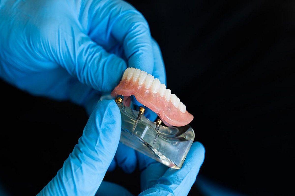 La pérdida o rotura de los dientes representa un 9,4% de los motivos principales por los que los españoles acuden al odontólogo.