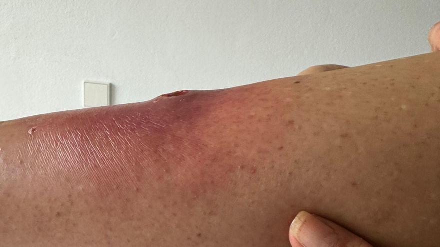 La pierna de la turista francesa tras sufrir la picadura de un arácnido