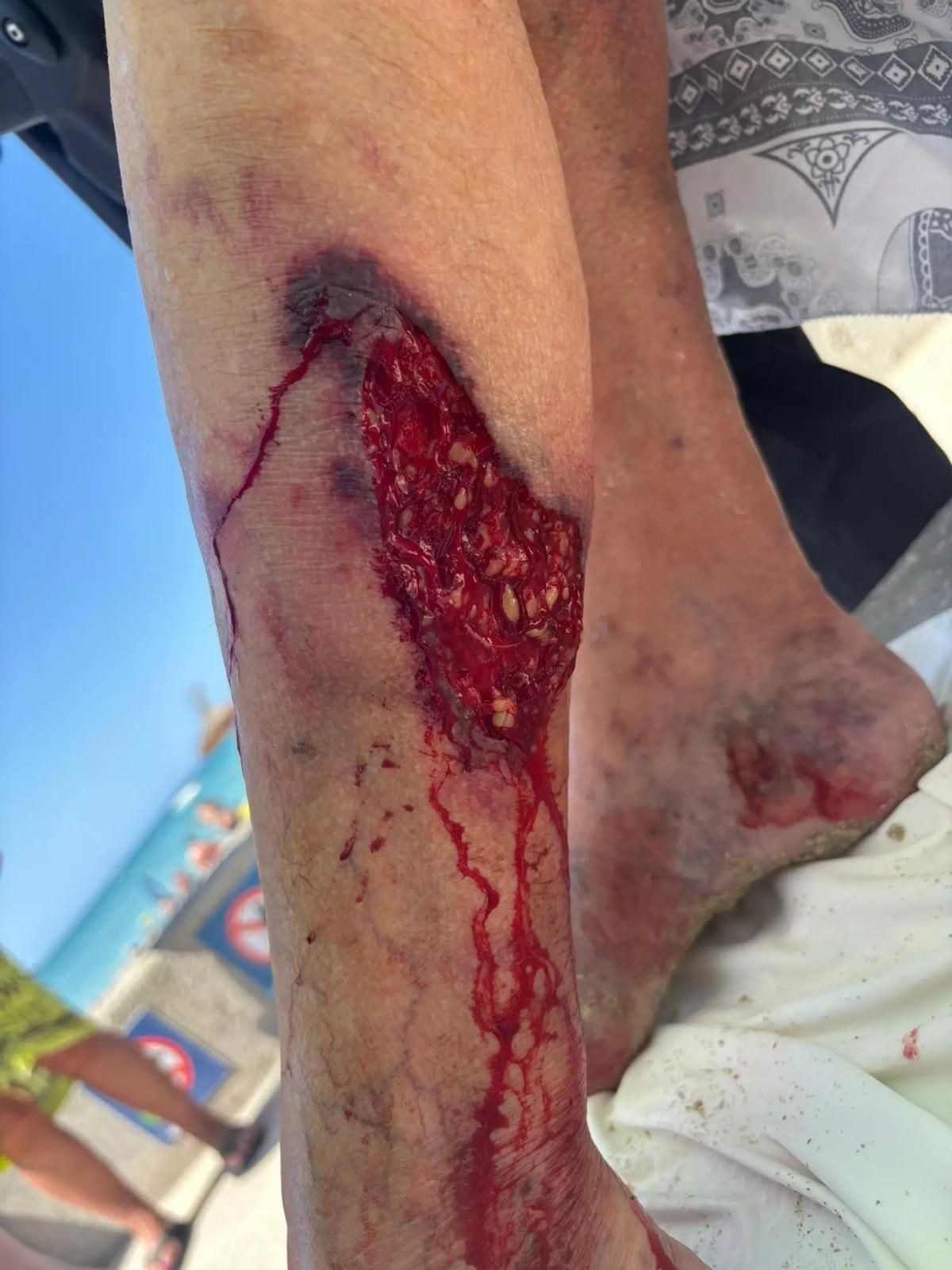 Herida en el gemelo izquierdo de la bañista italiana después de que un pez le arrancara un trozo de piel.