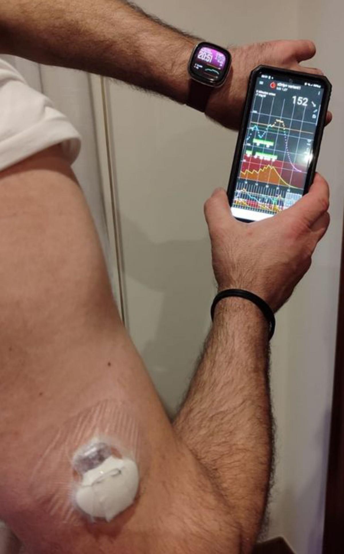 Un reloj recoge registros del sensor de glucosa en el brazo.