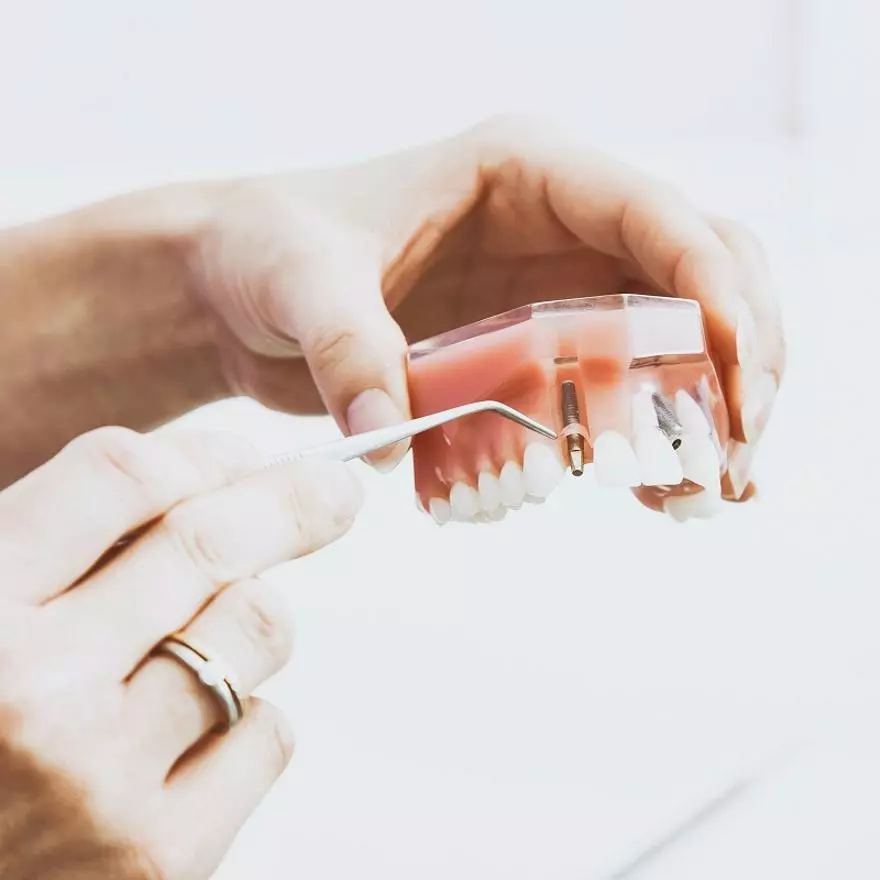 ¿Quién es un buen candidato para un implante dental?