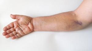 Un paciente con el brazo y la mano hinchados