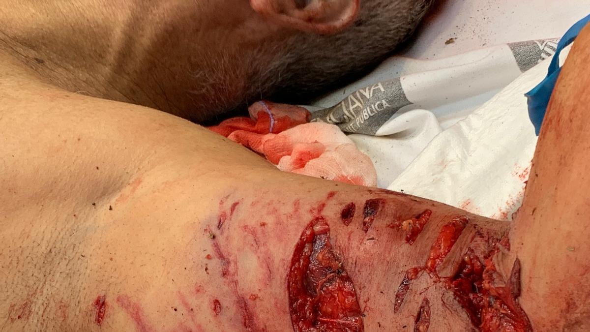 Lesiones en uno de los brazos del hombre atacado en Nàquera por sus perros.