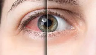 El 'ojo seco', la enfermedad que crece con las pantallas