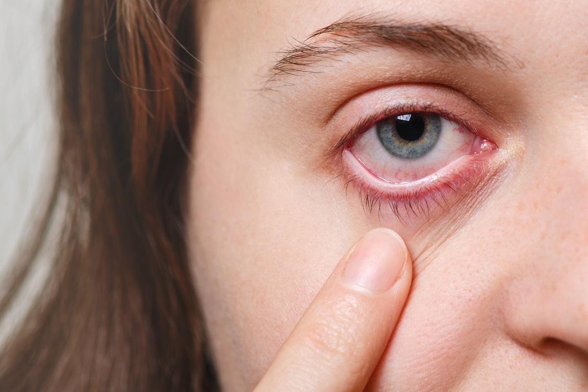 Los hábitos de vida y el cambio climático están detrás de las alergias oculares.