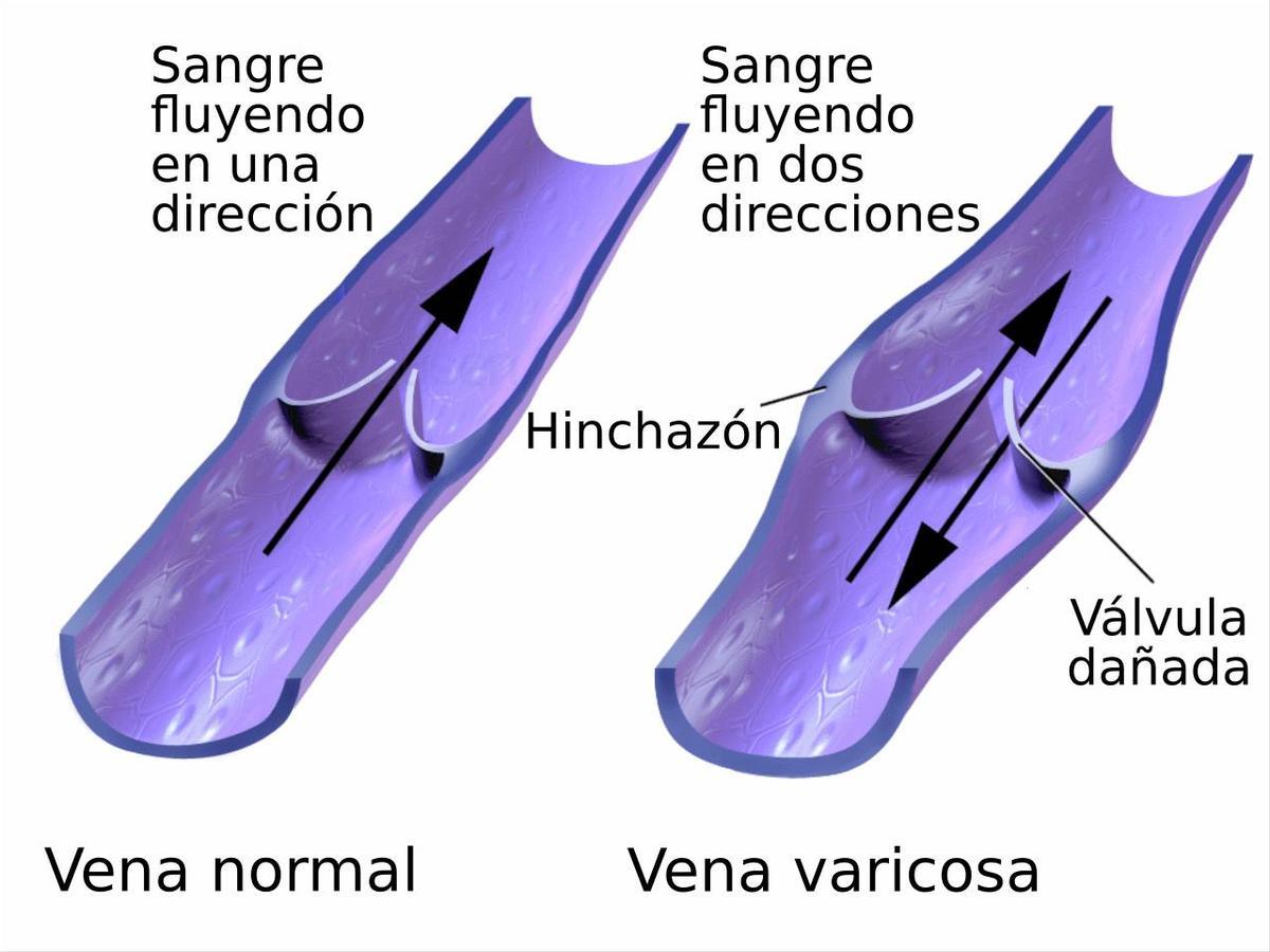 Venas varicosas