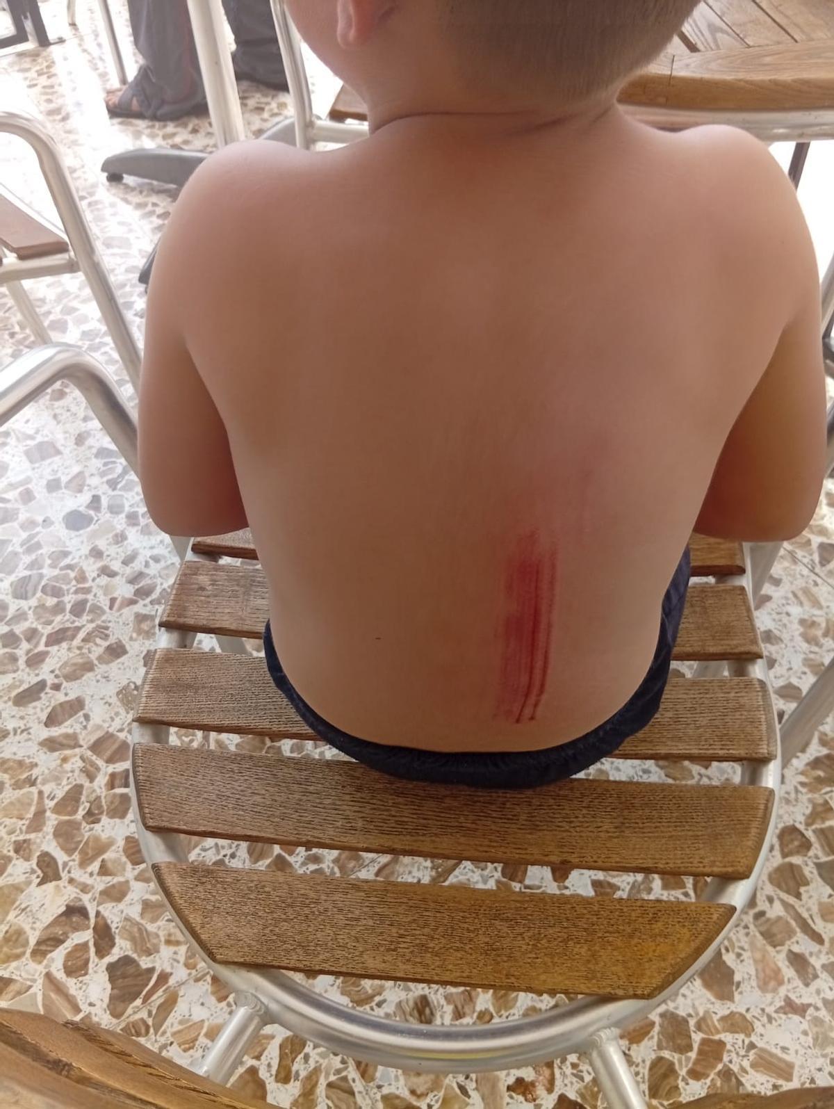 La espalda del niño, con un importante arañazo.