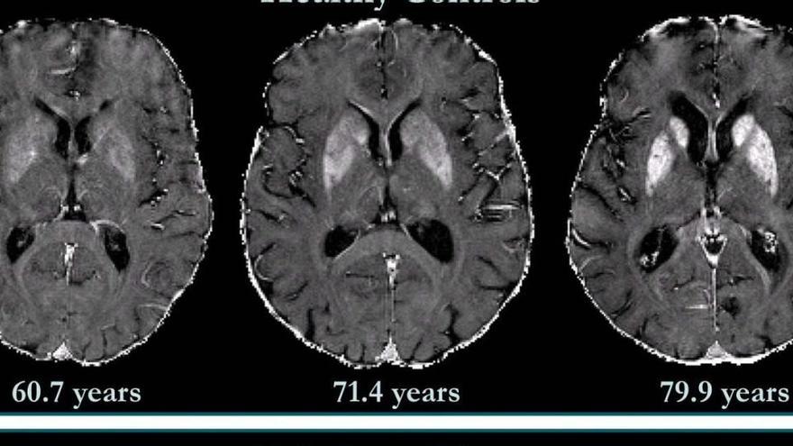 Les filles de pacients d&#039;Alzheimer tenen més risc de desenvolupar la malaltia