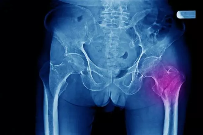 ¿Por qué la fractura de cadera es más frecuente en mujeres y tiene una tasa de mortalidad tan alta?