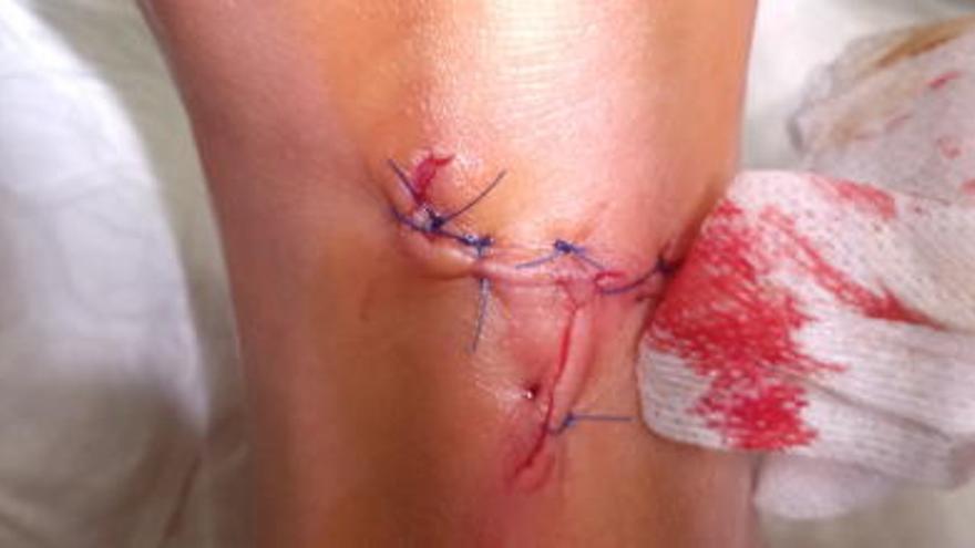 La herida en el pie de la bañista