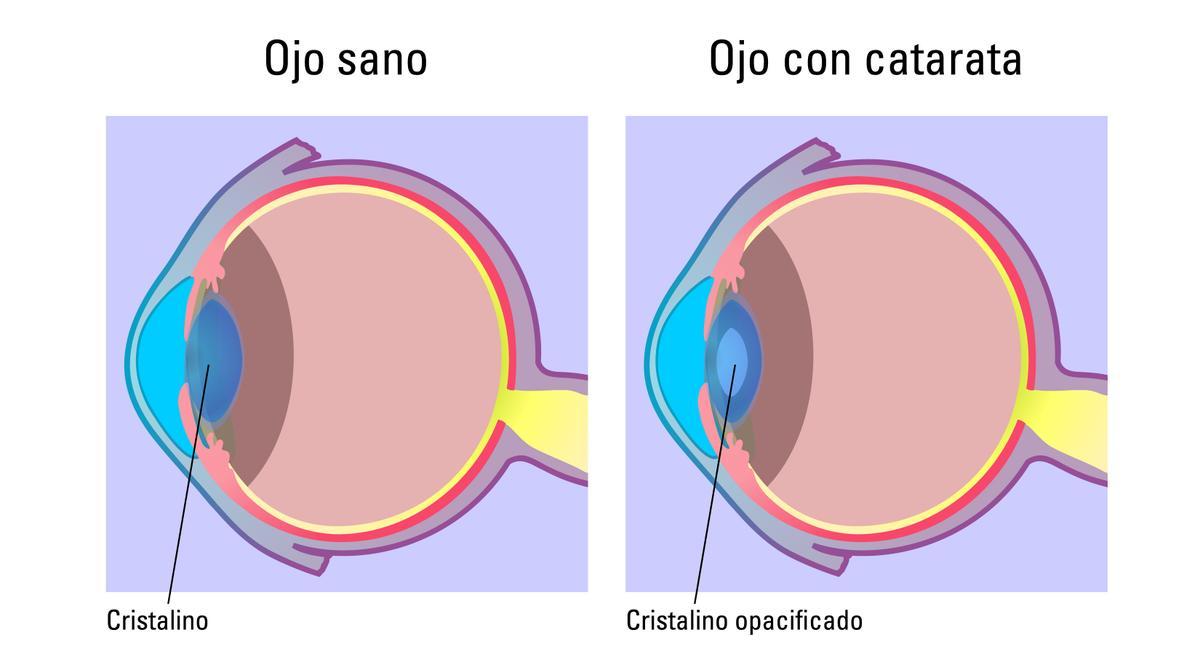 El cristalino (la lente natural del ojo) pierde su transparencia e impide la correcta visión.